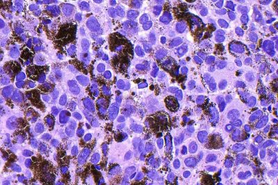 Experimental mRNA vaccine cuts risk that melanoma returns by 42%